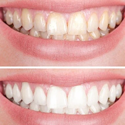 Smiley Éclaircissant Dentaire (Promotion)